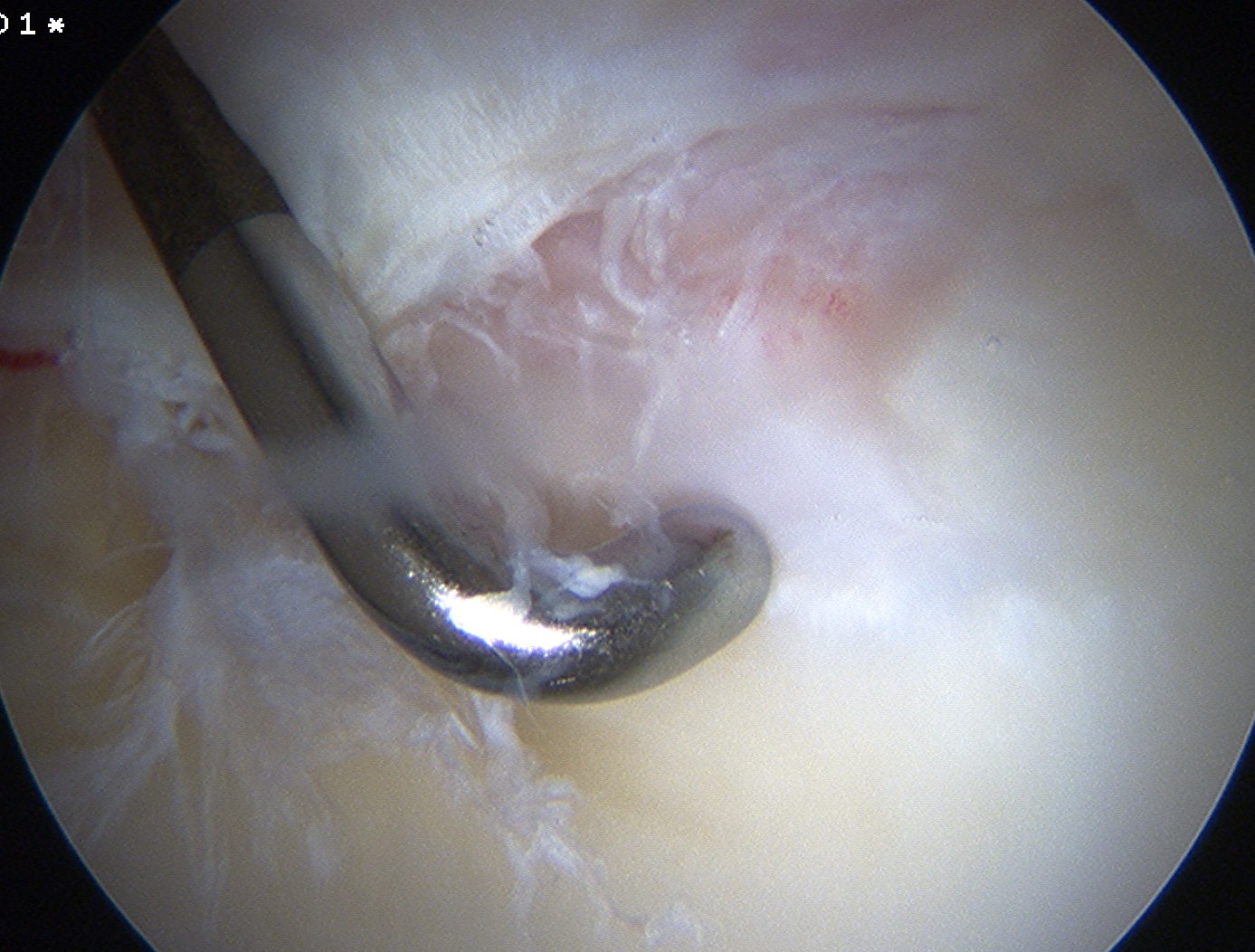 Hip Arthroscopy Degenerative Labral Tear From CAM lesion
